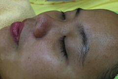 Before-peeling-flek-hitam